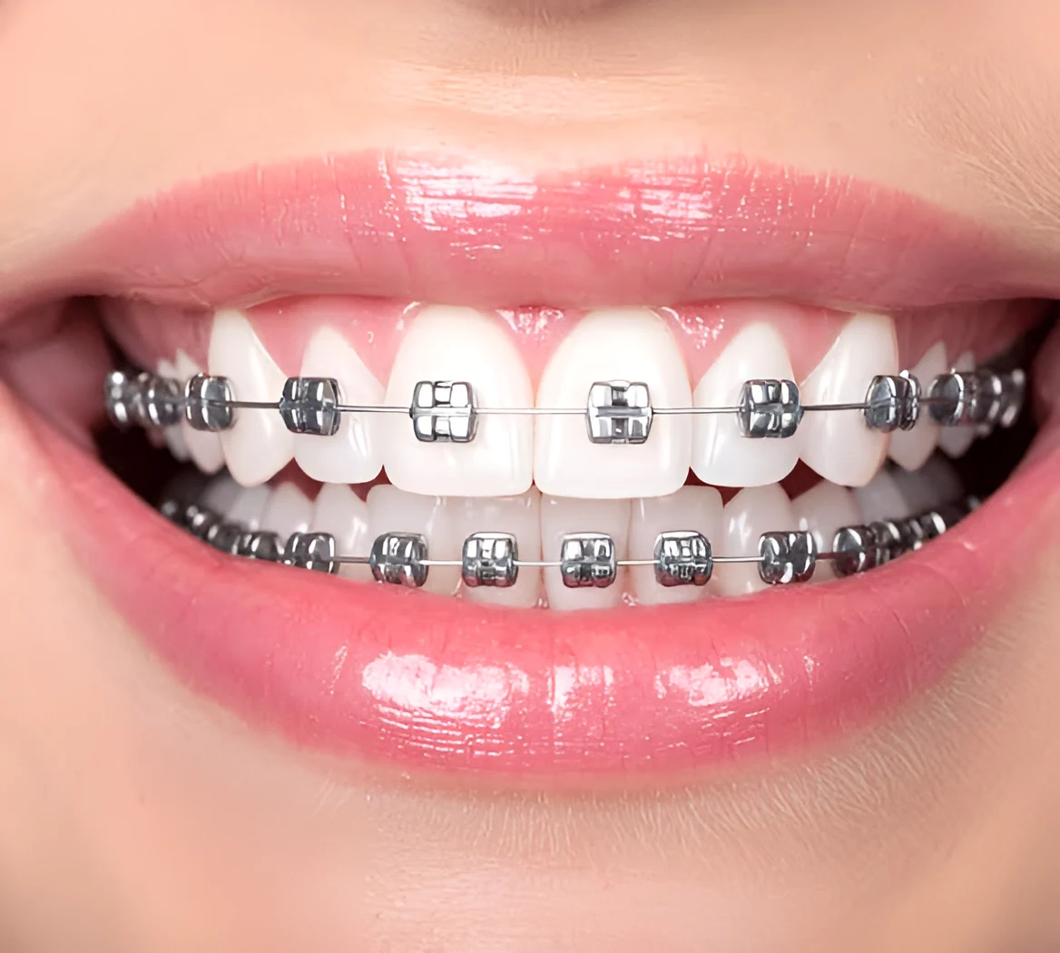 Close-up of a smile with modern metal braces