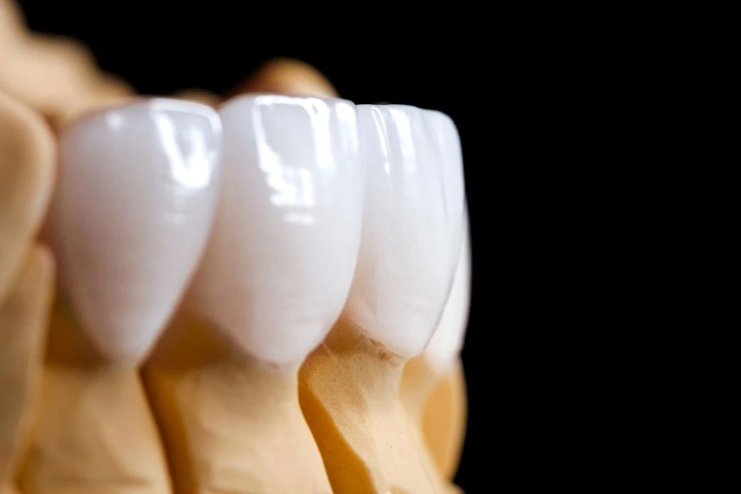 Ceramic crowns on a dental model