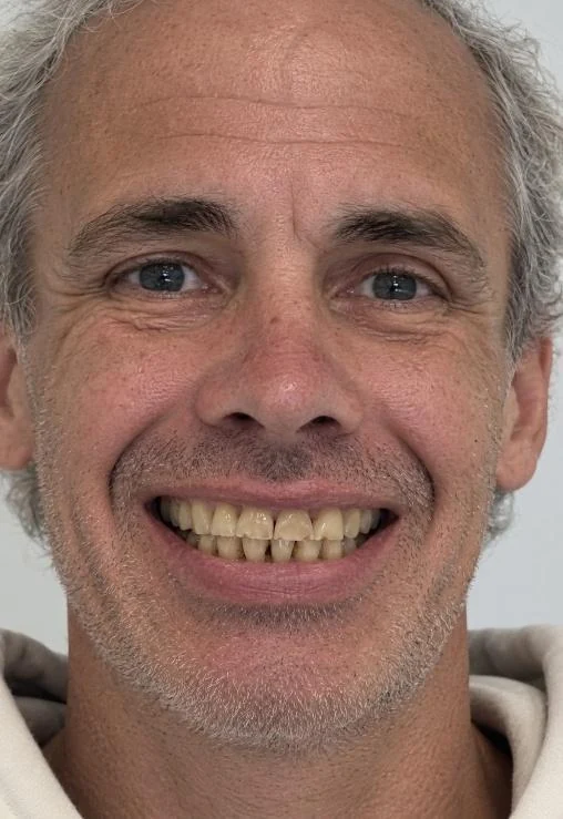 Patient smiling before cosmetic treatment