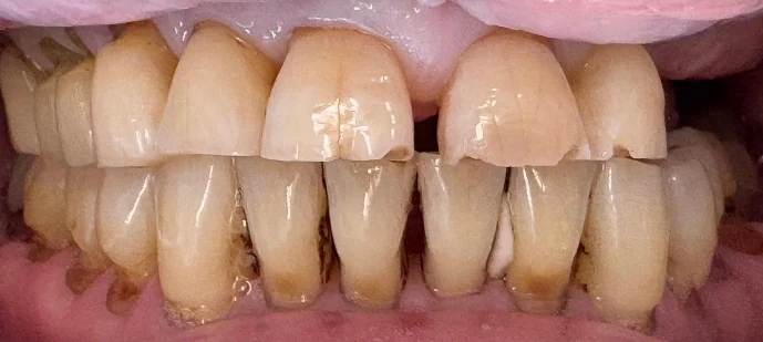 Worn and discoloured teeth before treatment
