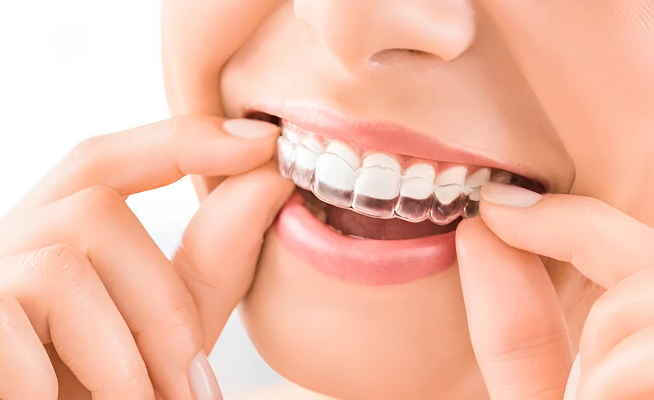 Fitting a clear aligner