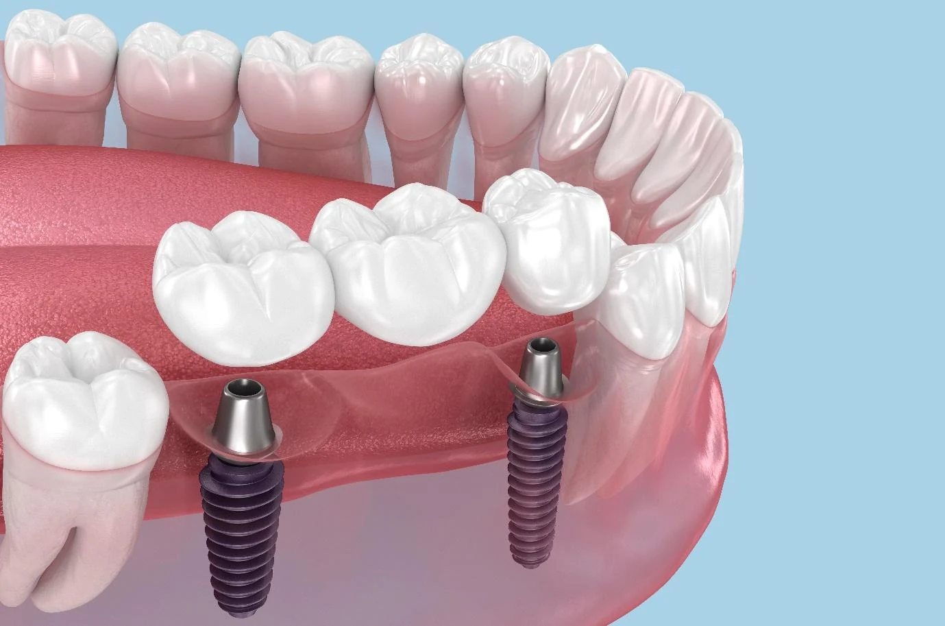 Illustration of implants supporting a bridge