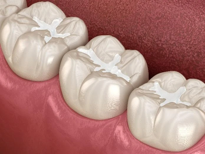 Illustration of fissure sealants protecting the grooves of back teeth
