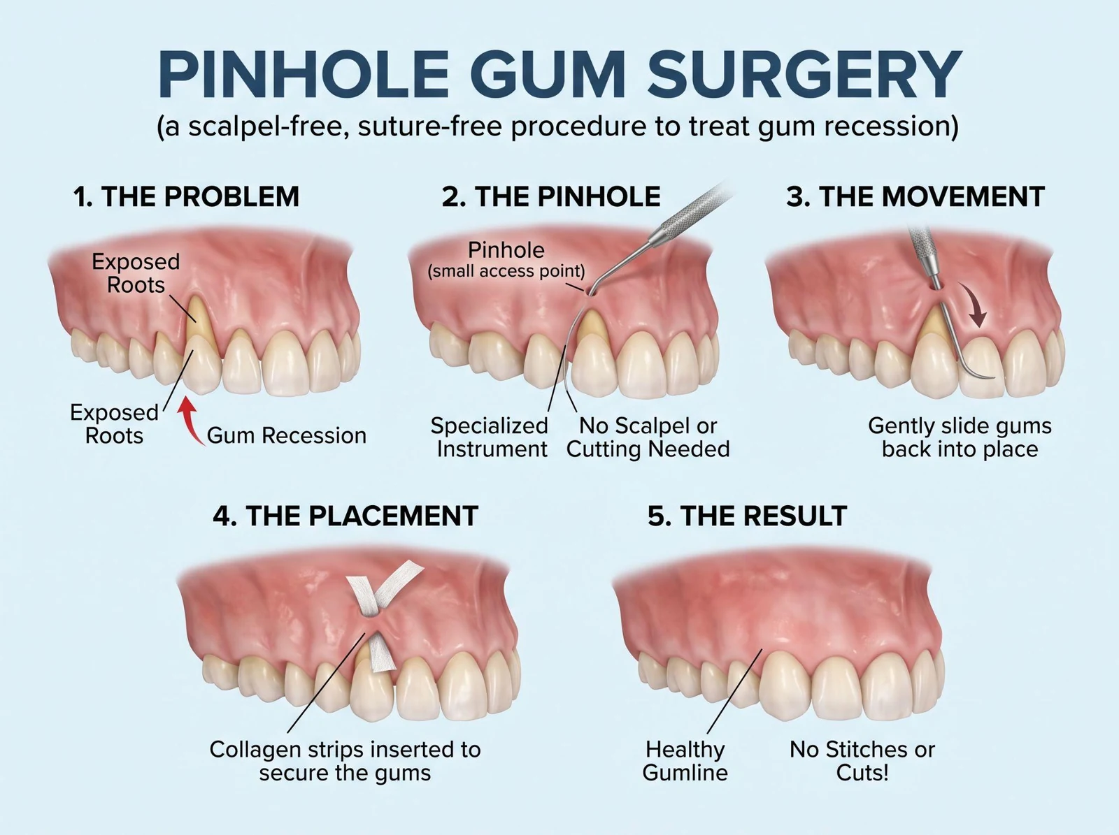 Infographic of the pinhole gum surgery steps: the problem, the pinhole, the movement, the placement and the result