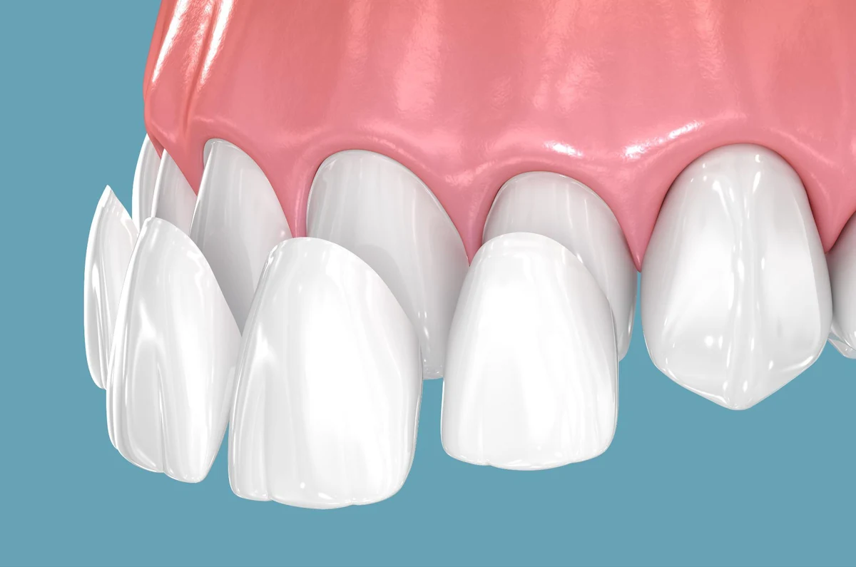 Illustration of thin porcelain veneers being placed over the front teeth