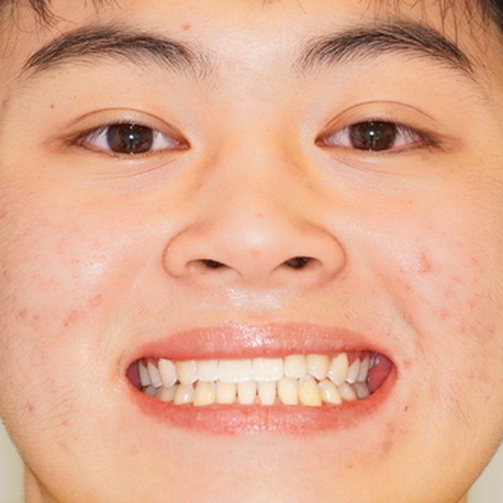 Patient 2 smiling after treatment