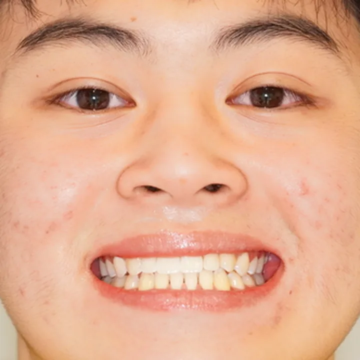 Patient 2 smiling after treatment