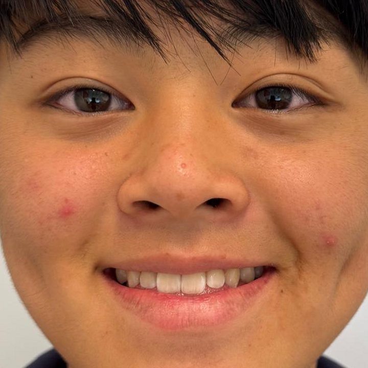 Patient 2 smiling before treatment