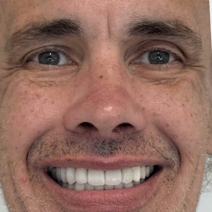 Patient 3 smiling after treatment